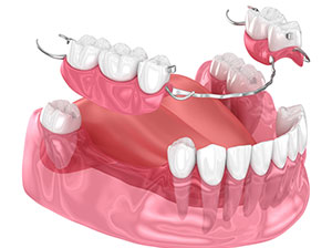 Partial Dentures, economical solution to replace missing teeth