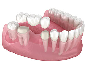 Porcelain dental bridges replacing missing teeth